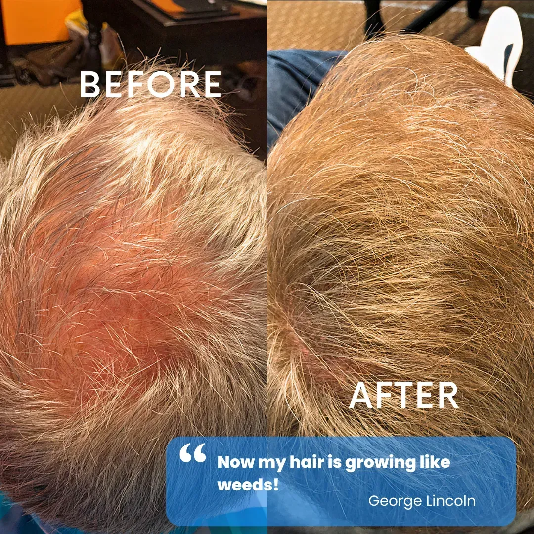 Hair restoration before and after — patient testimonial