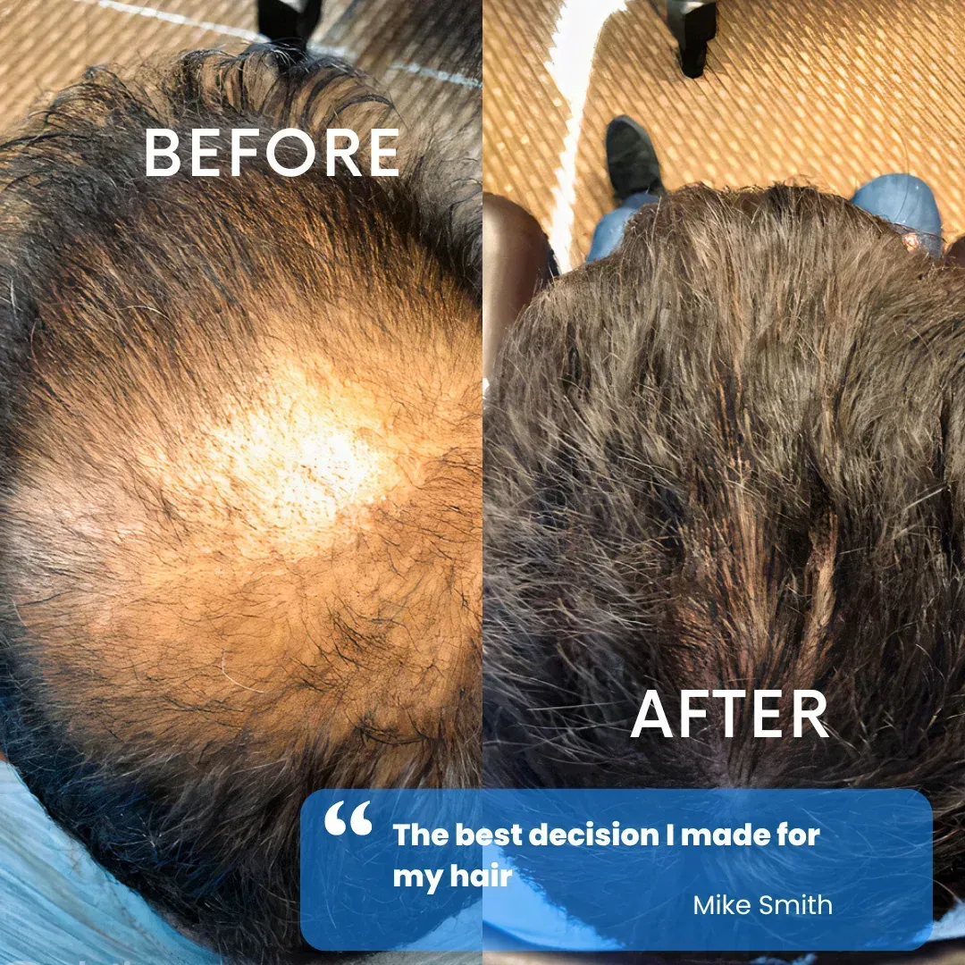 Hair restoration before and after — patient testimonial