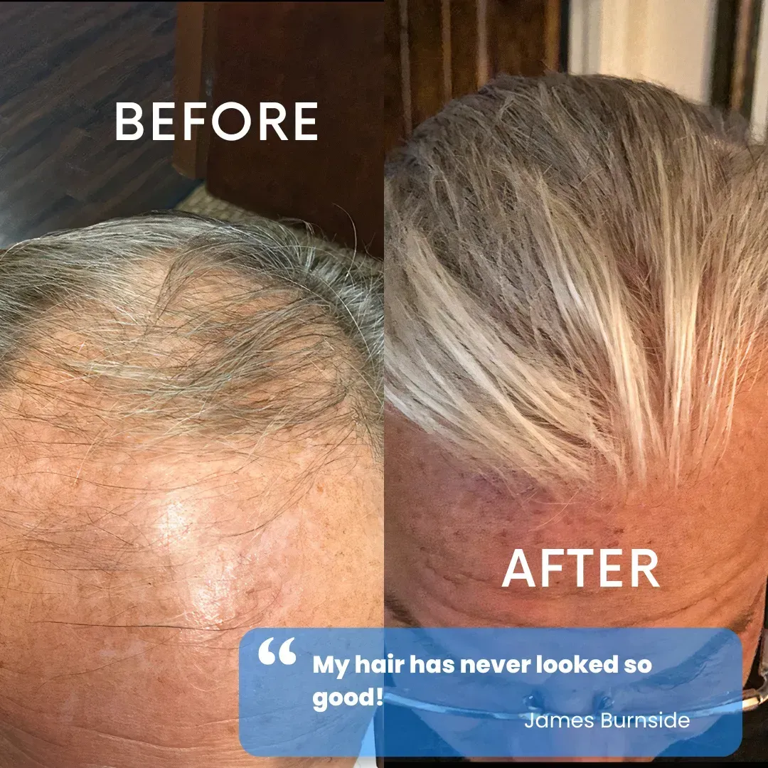 Hair restoration before and after — patient testimonial