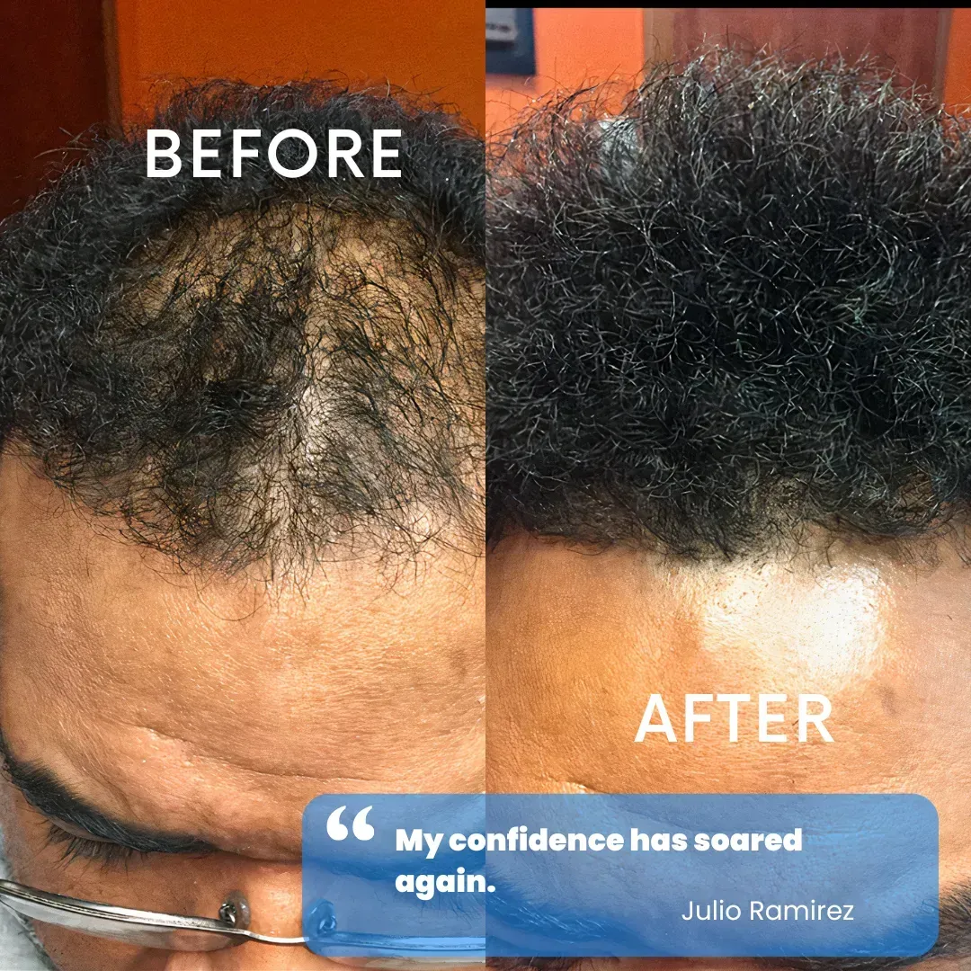 Hair restoration before and after — patient testimonial