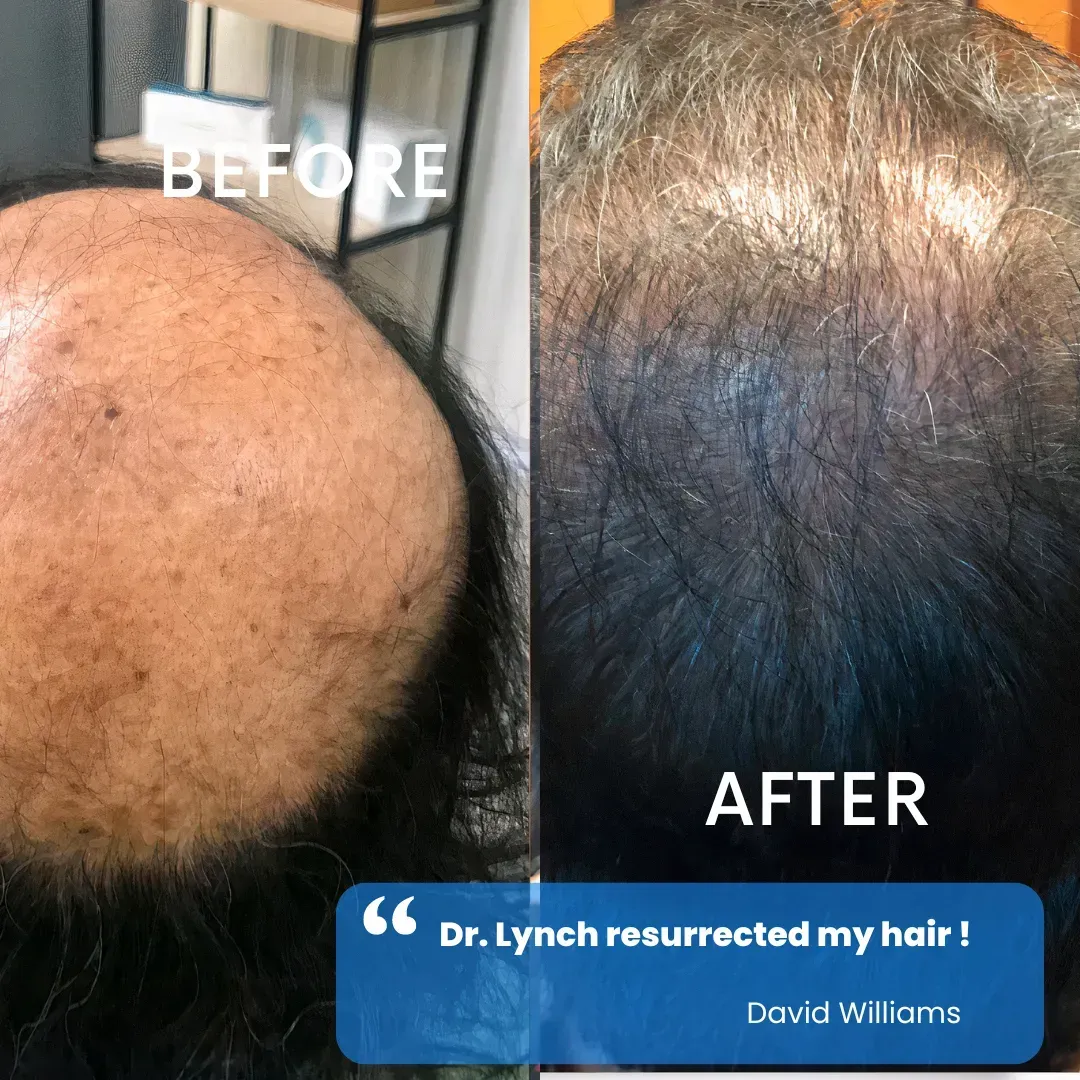 Hair restoration before and after — patient testimonial