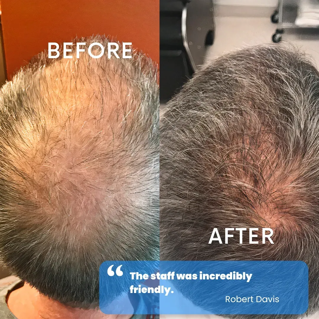 Hair restoration before and after — patient testimonial