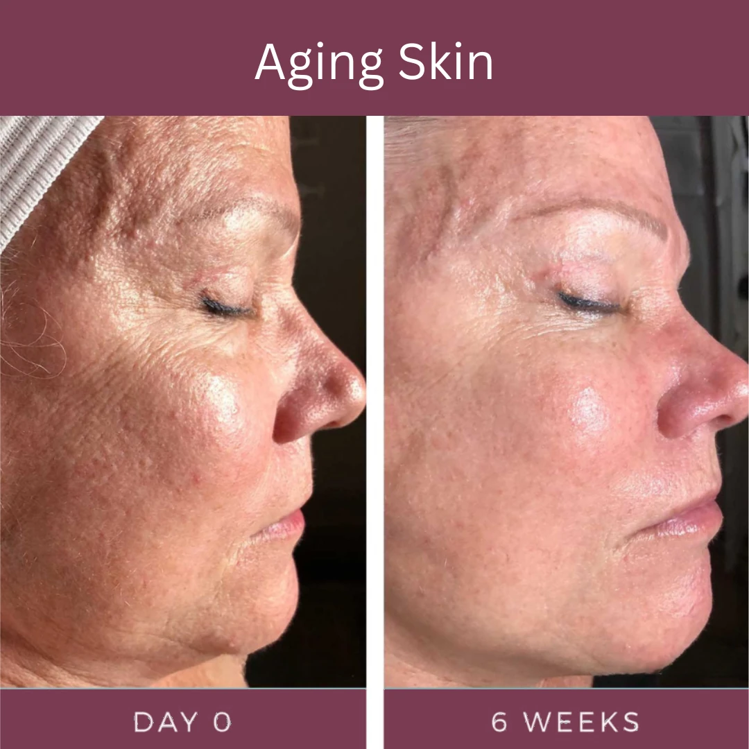 Aging skin, day 0 and 6 weeks