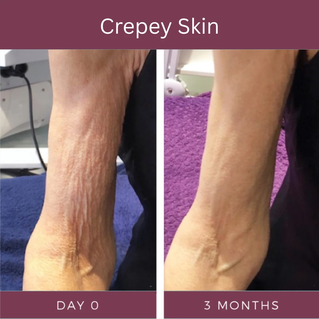 Crepey skin, day 0 and 3 months