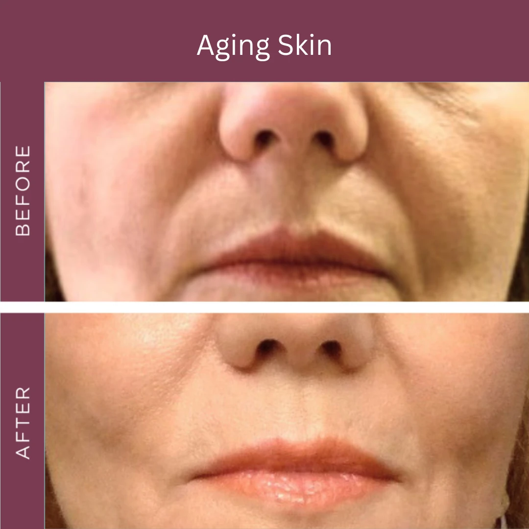 Aging skin, before and after