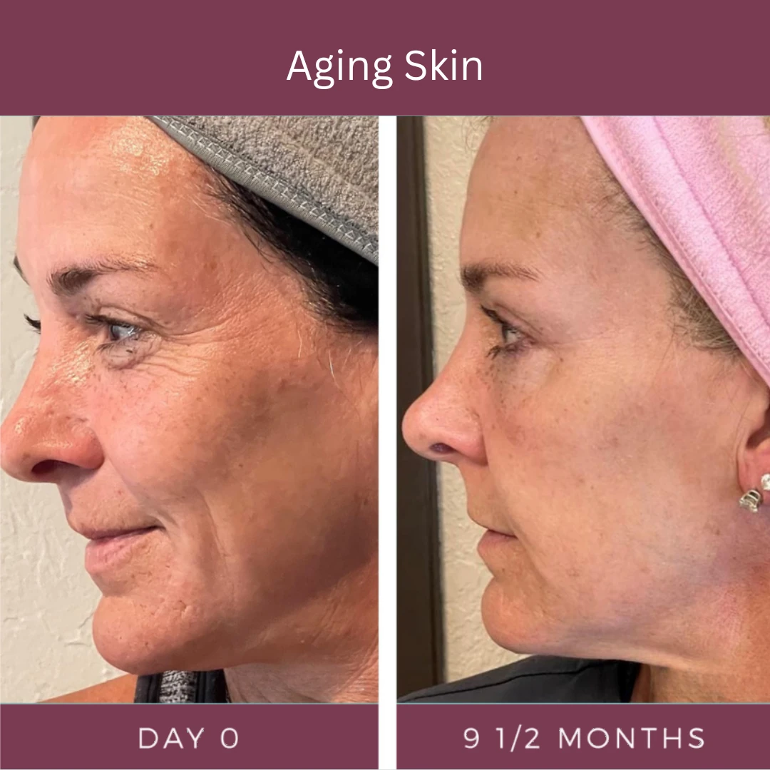 Aging skin, day 0 and 9 and a half months