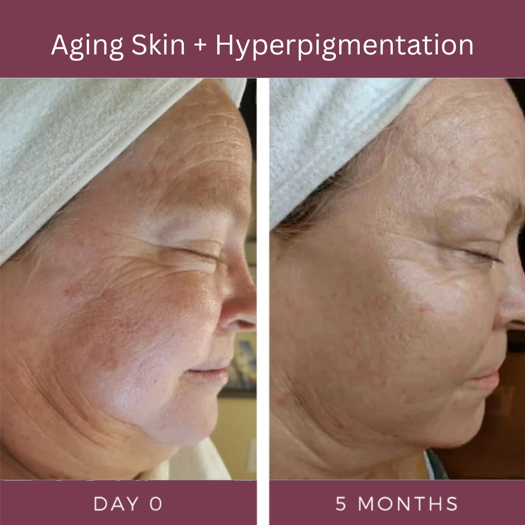 Aging skin with hyperpigmentation, day 0 and 5 months