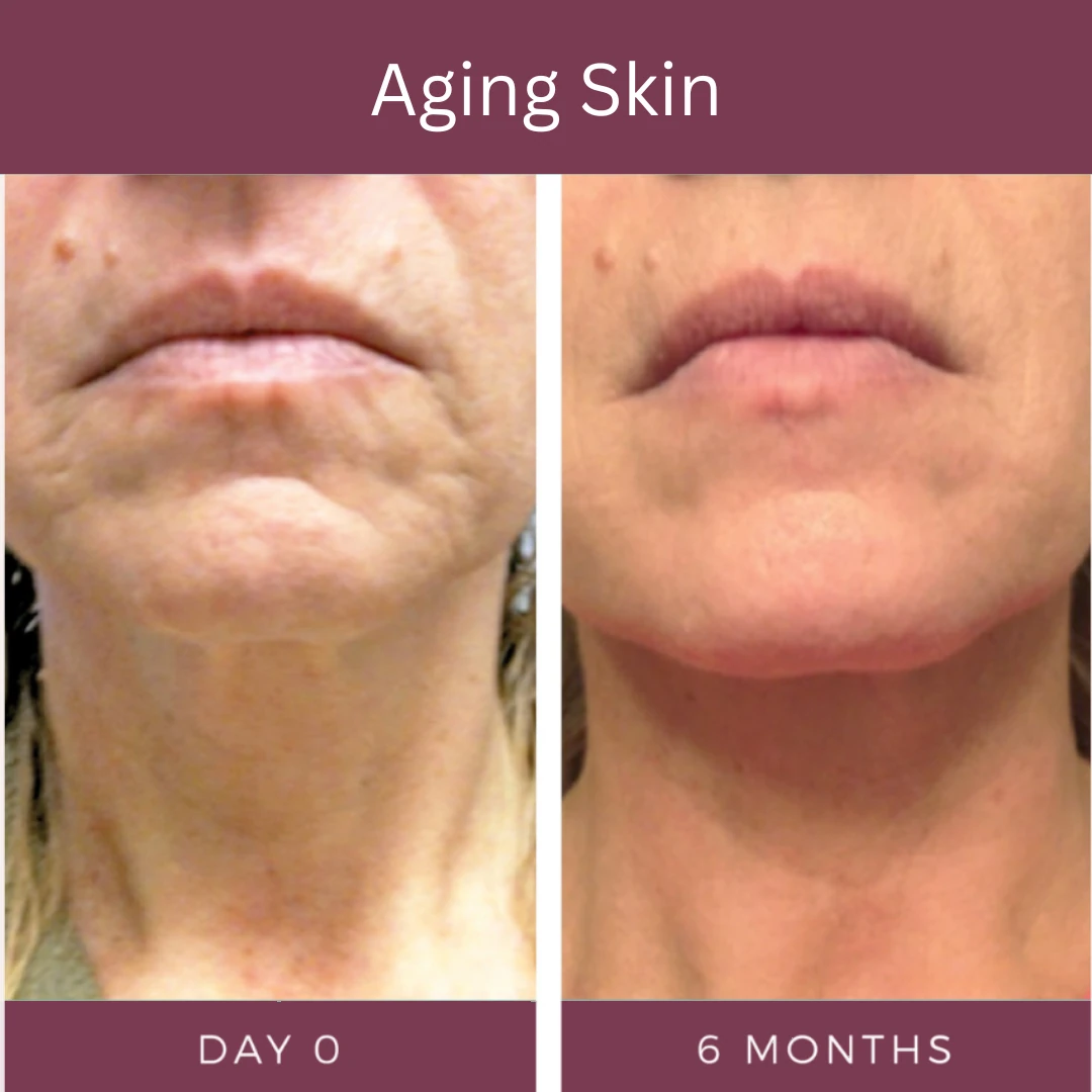 Aging skin, day 0 and 6 months