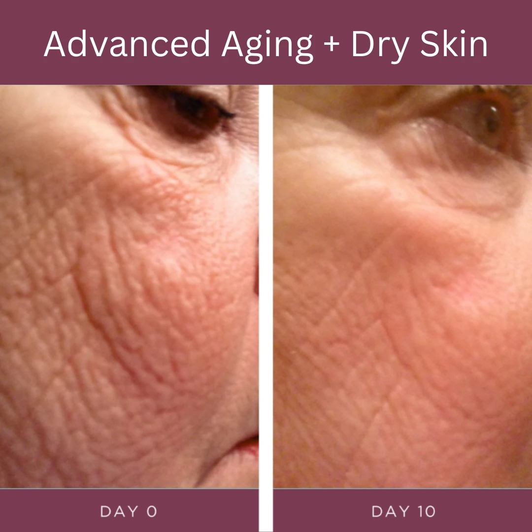 Advanced aging and dry skin, day 0 and day 10