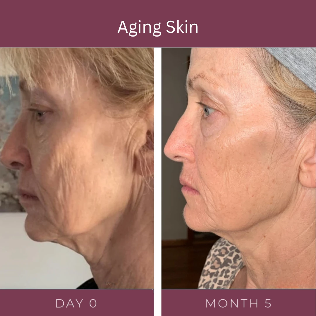 Aging skin before and after an Exosome Facial treatment series, day 0 and month 5